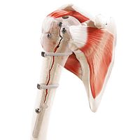Periprosthetic fracture bone cerclage wiring Strapflexmultifilament polymer
