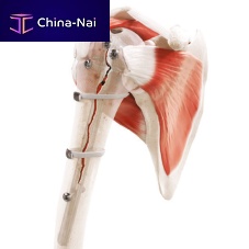 Periprosthetic fracture bone cerclage wiring Strapflexmultifilament polymer