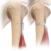 Biceps tendon suture anchor FiberTak® 2-0 FiberLink non-absorbable