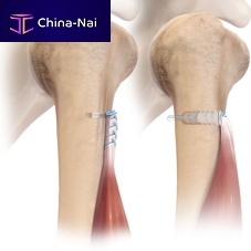 Biceps tendon suture anchor FiberTak® 2-0 FiberLink non-absorbable