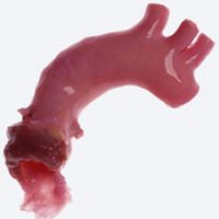 Aorta vascular bioprosthesis CryoValve®allograftwith valve
