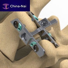 Lumbar interspinous vertebral implant Reli SPsacralthoracic