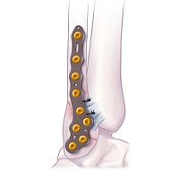 Fibula compression plate VOLITION malleolusdistallateral