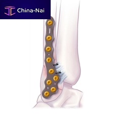 Fibula compression plate VOLITION malleolusdistallateral