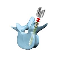 Lumbar pedicle screw �mediRod®�-Tripolyaxialcannulated