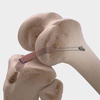 Anterior cruciate ligament ligament prosthesis CorTTape®posterior cruciate ligamentsynthetic