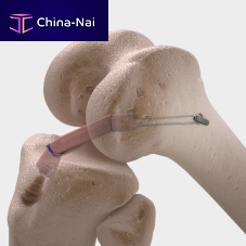 Anterior cruciate ligament ligament prosthesis CorTTape®posterior cruciate ligamentsynthetic