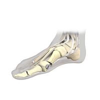 Hallux valgus osteotomy screw Stoffellametatarsal bonemetatarsophalangeal jointmetallic