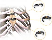 Sternal closure bone cerclage wiring Sternalink metalic monofilament