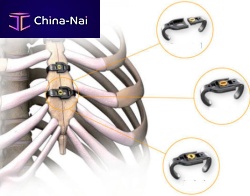 Sternal closure bone cerclage wiring Sternalink metalic monofilament