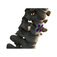 Cervical arthrodesis plate SETx metallic1 level