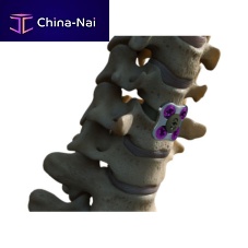 Cervical arthrodesis plate SETx metallic1 level