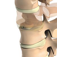 Cervical interbody fusion cage Ti-6Al-4V ELIanteriortitaniumPEEK