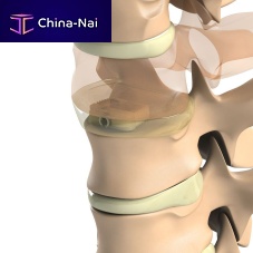 Cervical interbody fusion cage Ti-6Al-4V ELIanteriortitaniumPEEK
