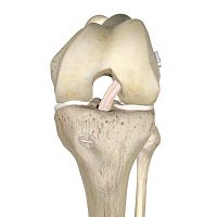 Anterior cruciate ligament ligament prosthesis ANCHORMAN synthetic