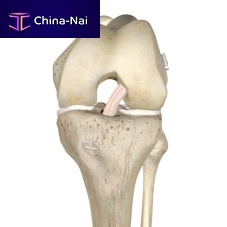 Anterior cruciate ligament ligament prosthesis ANCHORMAN synthetic