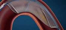 Aortic embolic protection system FLOWer