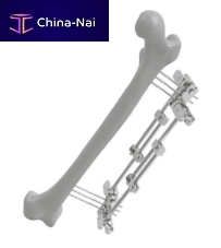 Femur external fixation system 201502tubularadult