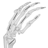 Hand phalange arthrodesis screw carpal jointheadless