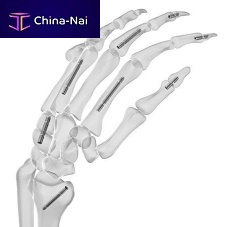 Hand phalange arthrodesis screw carpal jointheadless