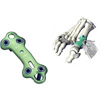 Forefoot arthrodesis plate UltOSfoot phalangelockingnon-locking