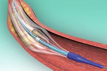 PTCA catheter POWERLINEcoronaryballoonhydrophilic
