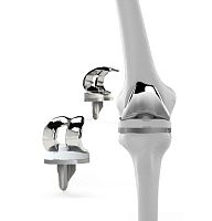 Total knee prosthesis 7513sliding, posterior stabilizedfixed-bearingcemented or non-cemented