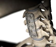 Cervical vertebra arthrodesis plate S-1bioresorbable polymer2 levels1 level