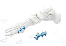 Foot phalange arthrodesis plate 400102x seriestitanium