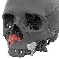 Maxillofacial reconstruction resection guide