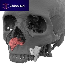 Maxillofacial reconstruction resection guide