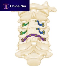 Cervical vertebra laminoplasty plate Ritavertebra