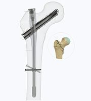 Femoral intramedullary nail 4552-1017proximal fixationrightleft