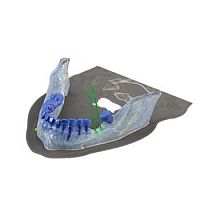 Dental implantology software Reconstruction 3Dfor dental implant simulation3D viewingmodeling