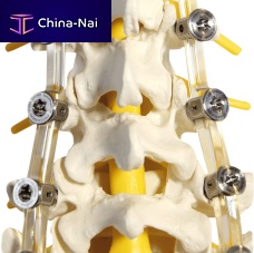 Lumbar osteosynthesis unit SpineShape System IVposterioradult