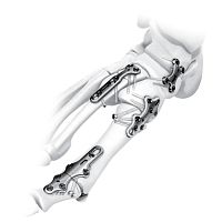 Tarsal joint compression plate metatarsophalangeal jointtarso-metatarsal jointlocking