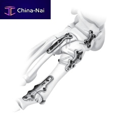 Tarsal joint compression plate metatarsophalangeal jointtarso-metatarsal jointlocking