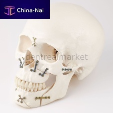 Maxillofacial compression plate 56.10.116Ametallic