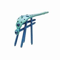Ulna osteotomy plate olecranonproximallocking