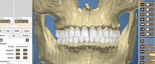 Dental software OrthoAnalysisanalysistreatmentsimulation