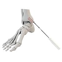 Malleolus arthrodesis screw cannulatedtitaniumcortical