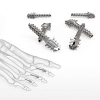 Metatarsophalangeal joint compression bone screw ExtremiFuse metallic