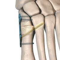 Hallux valgus osteotomy plate dynaBunion®