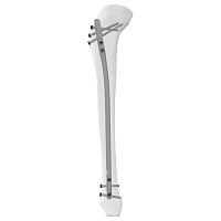 Tibial intramedullary nail 305014 seriesproximal fixationdistal fixationright