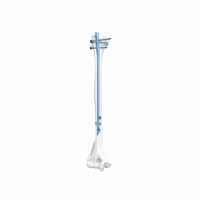 Humeral intramedullary nail mid-shaft fixationproximal fixationmetallic