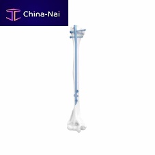 Humeral intramedullary nail mid-shaft fixationproximal fixationmetallic