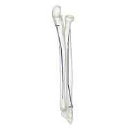 Ulnar intramedullary nail 83527 seriesradiustitanium
