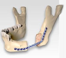 Mandible osteotomy plate CARCITEK lockingmetallic