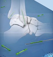 Foot arthrodesis screw anklehandcannulated