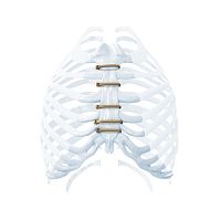 Sternal closure bone cerclage wiring ZIPFIXmetalic monofilament